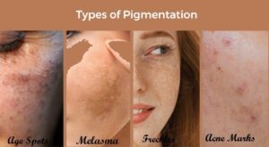 pigmentation