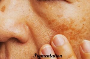 Pigmentation